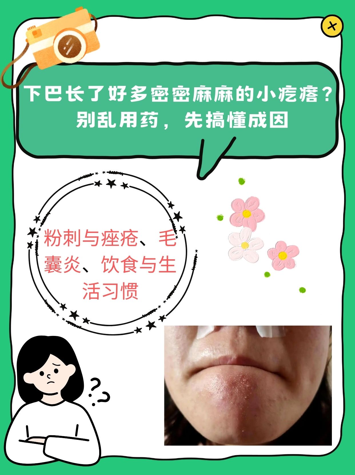 为什么下巴总是长痘