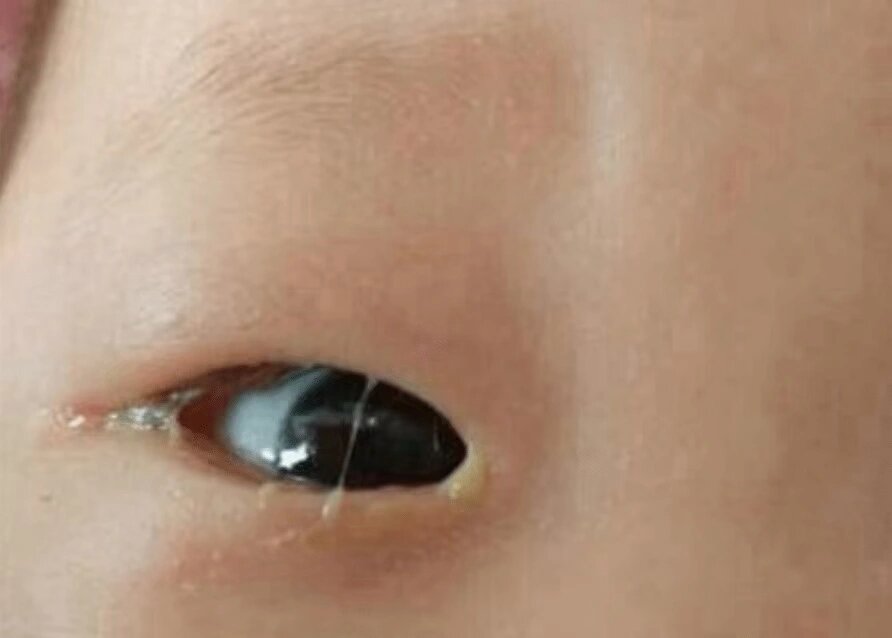 婴儿眼屎多怎么回事