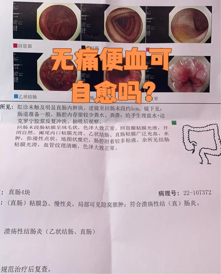 大便出血,没有疼痛感?怎么办