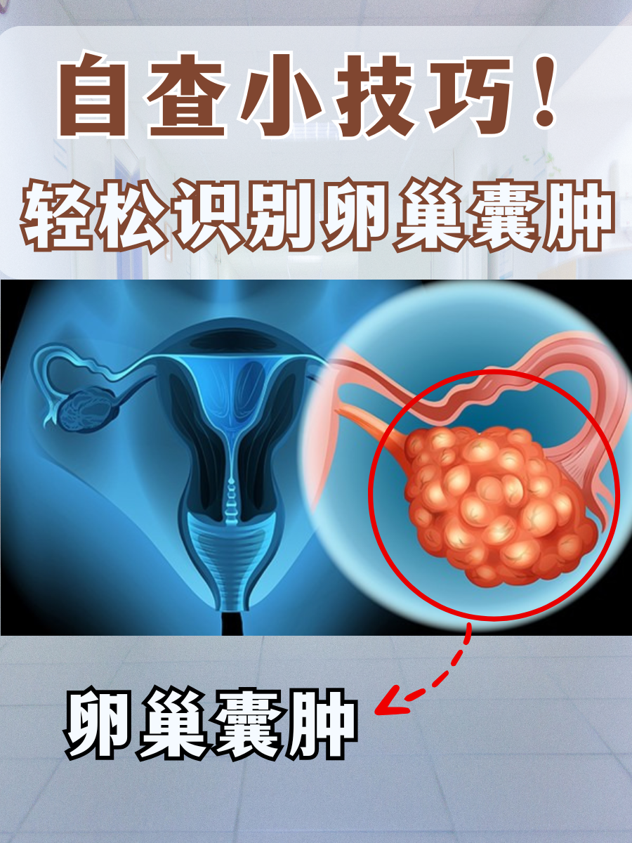 卵巢囊肿是什么原因引起的