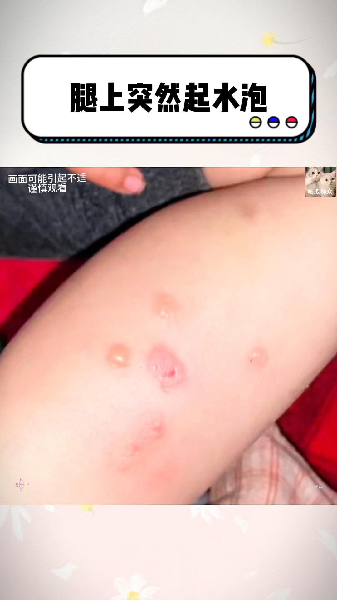 身上起水泡是怎么回事