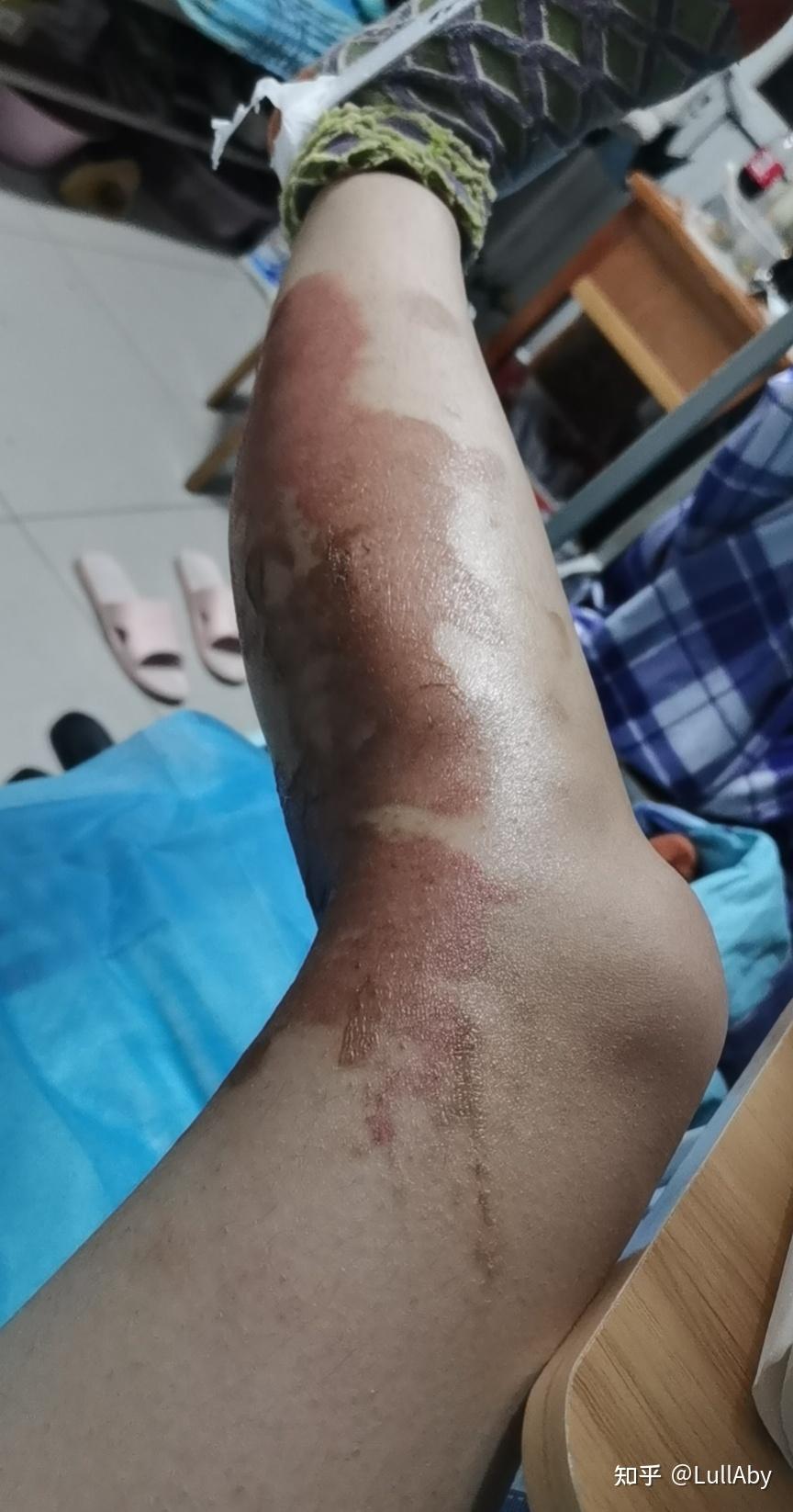 浅二度烧伤多少天能好