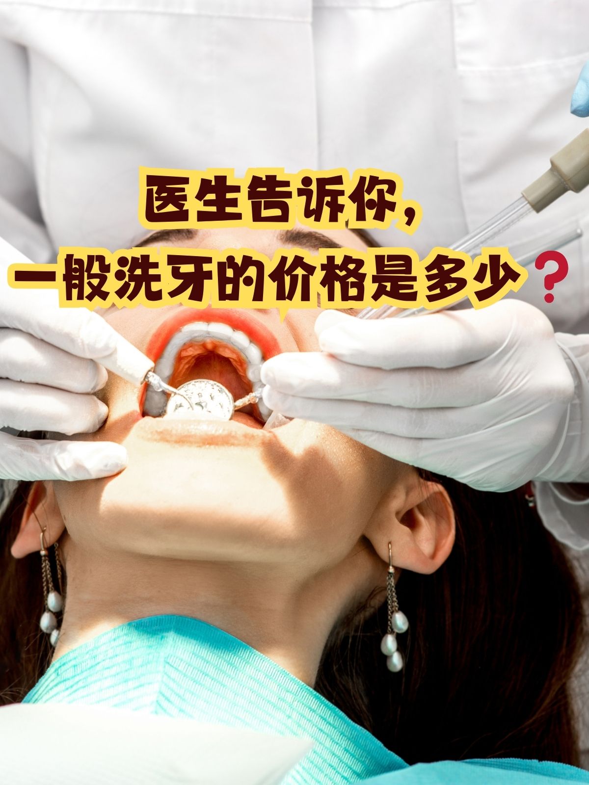洗牙一般多少钱