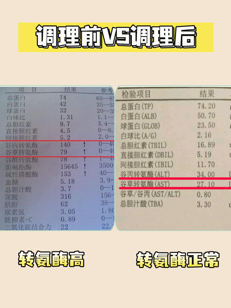 谷丙转氨酶偏高严重吗