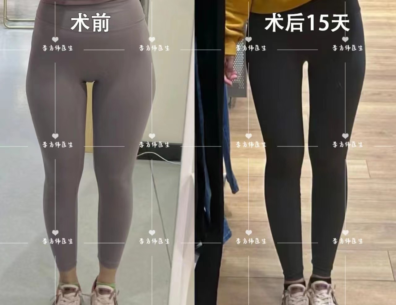 胯大腿瘦,两腿之间缝隙大,该怎么办