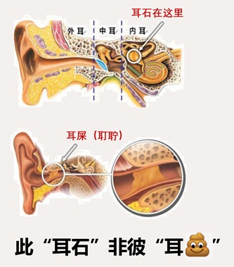 耳石症症状