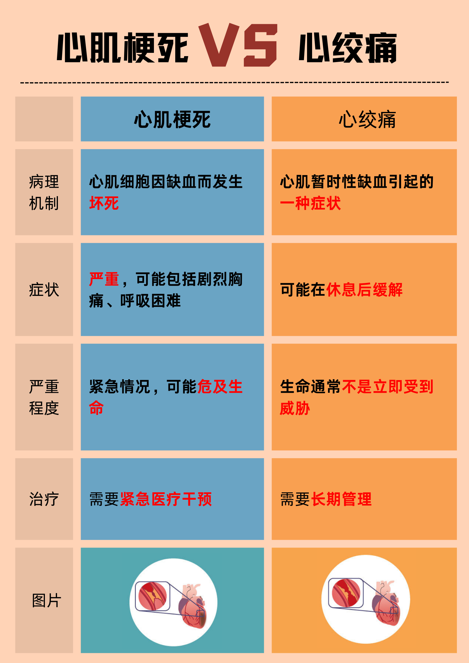 心梗的最好治疗方法是哪些