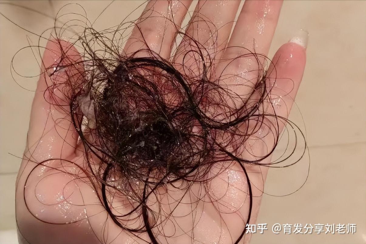 为什么老是掉头发?