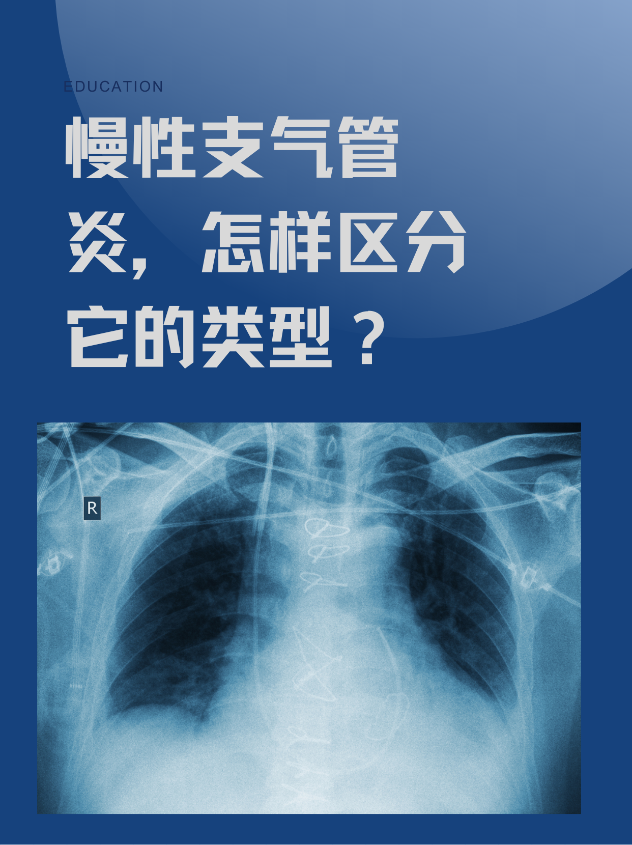 慢性支气管炎怎么根治?