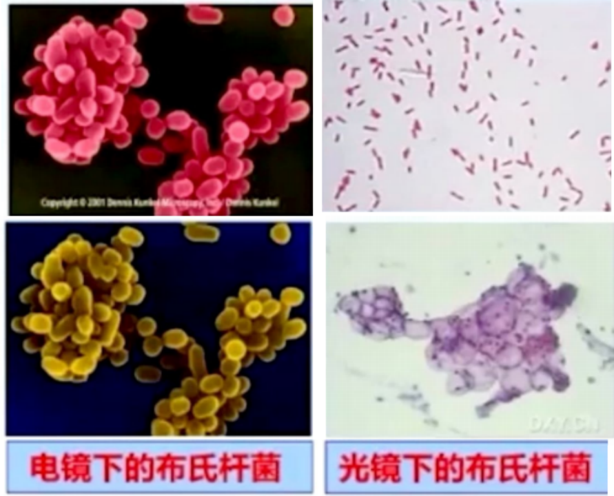 什么是布氏菌病?