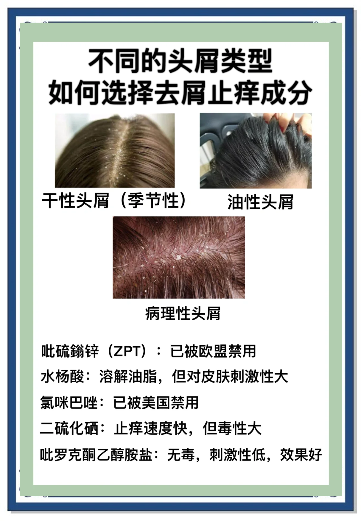 怎样去头皮屑