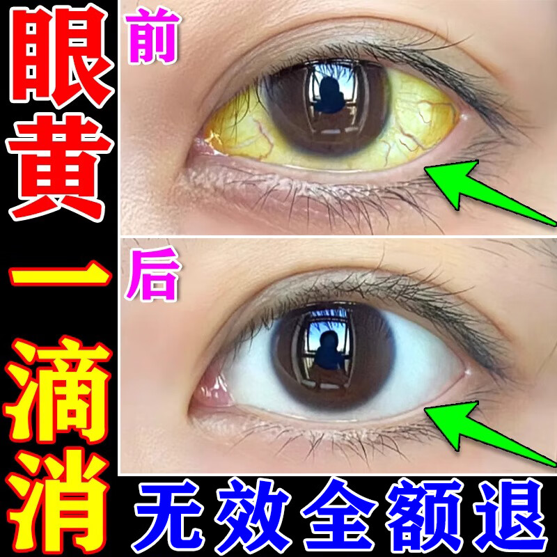 眼睛白眼球上有黄斑正常吗