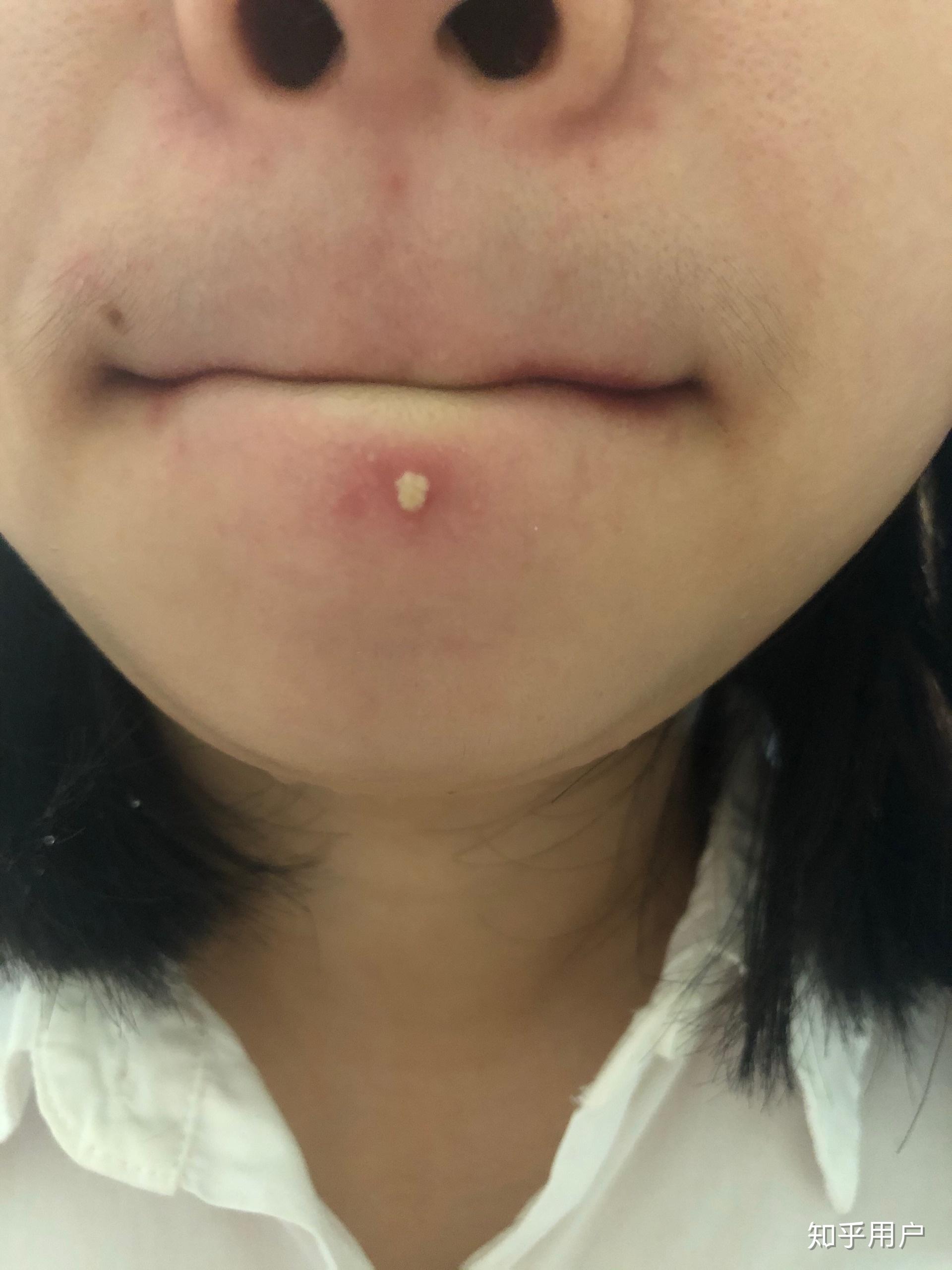 下巴长疙瘩