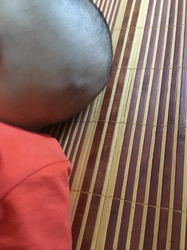 婴儿后脑勺有个坑