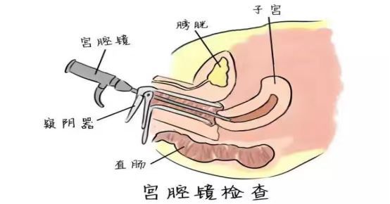 宫腔镜清宫和一般清宫有什么区别?