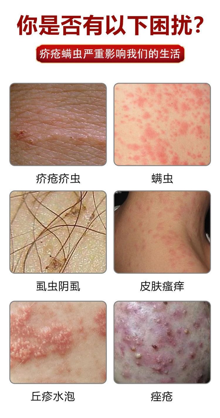 疥疮可以治好吗