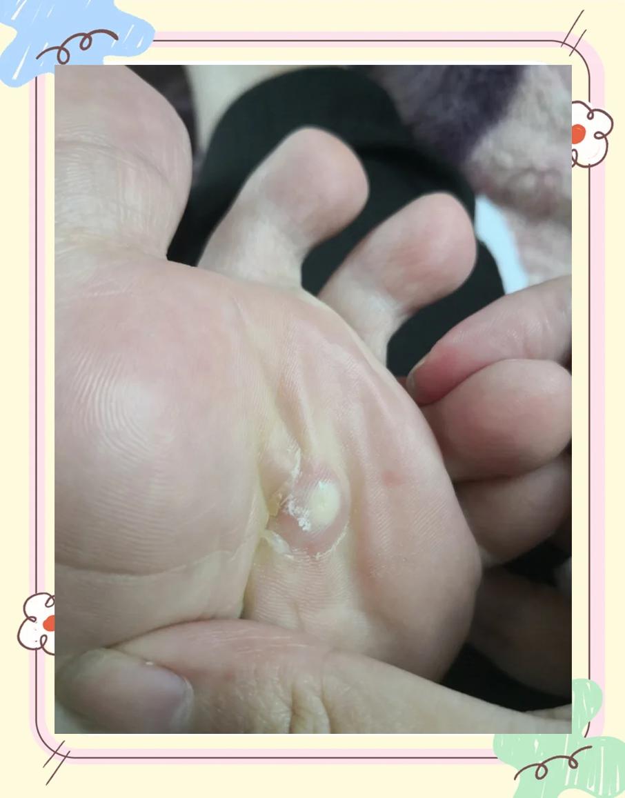 治疗鸡眼最好的方法是什么