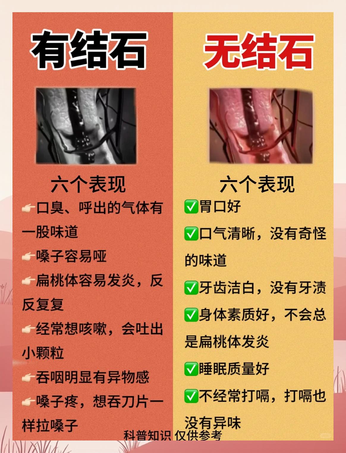 扁桃体结石怎么取出来