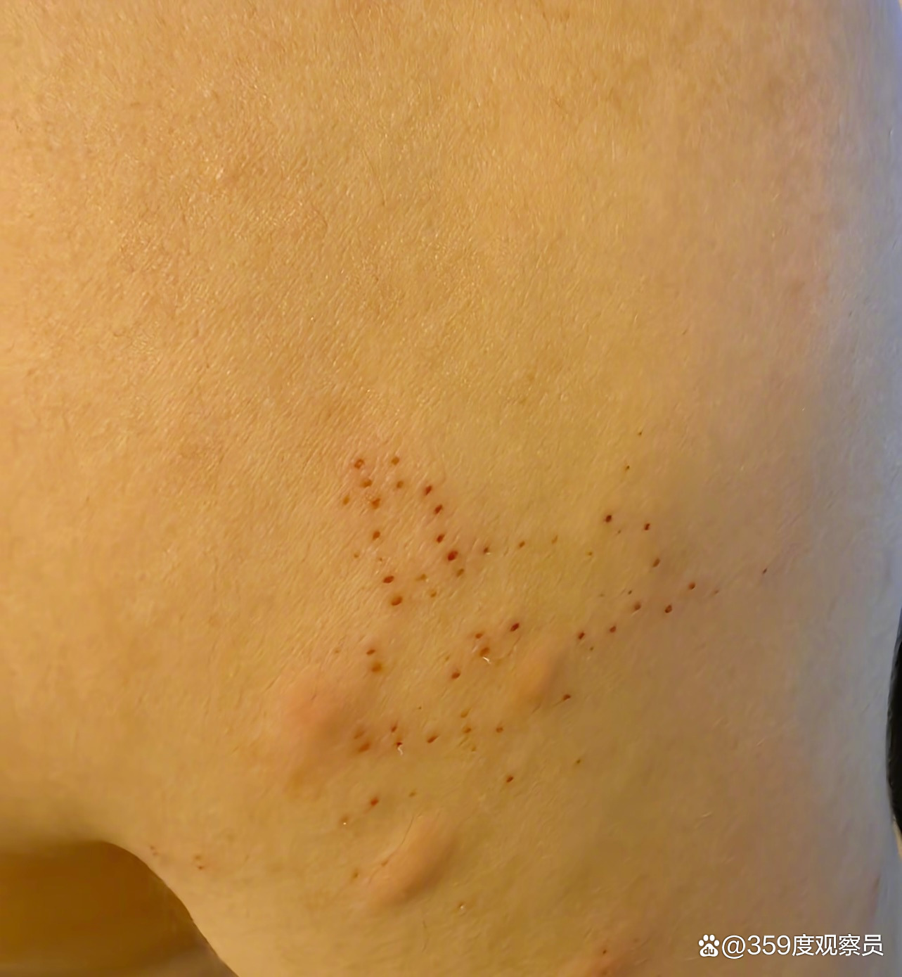 被毛毛虫蛰了怎么办.