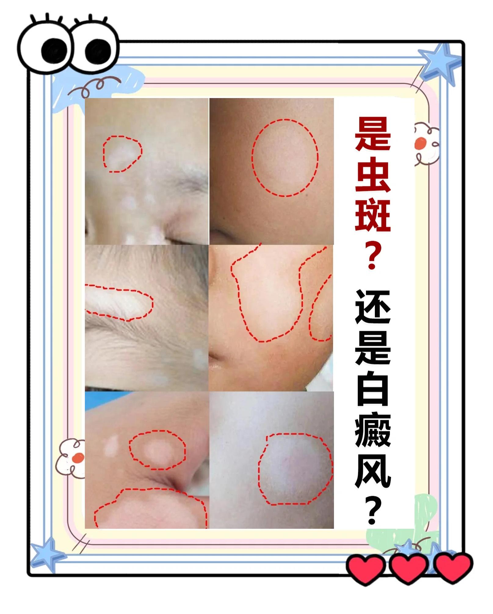 小孩脸上有淡白斑怎么回事