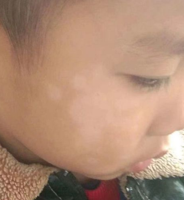 小孩脸上有淡白斑怎么回事