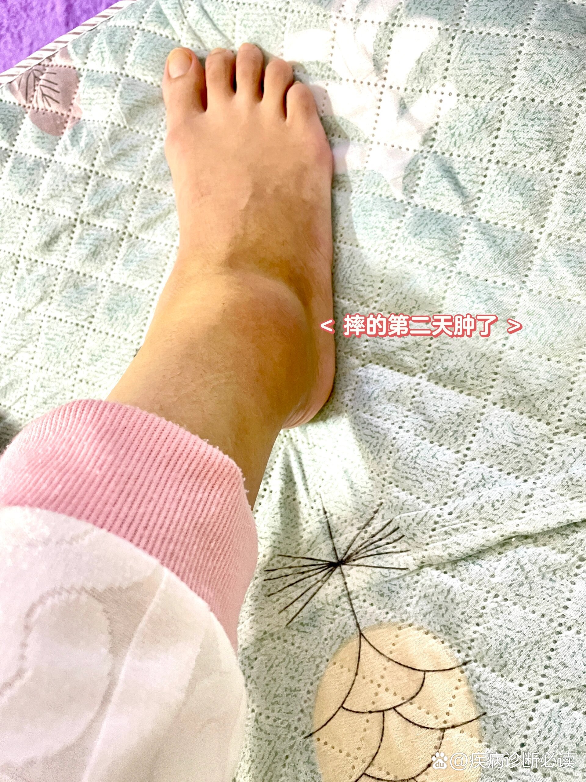 滑膜炎症状有哪些症状