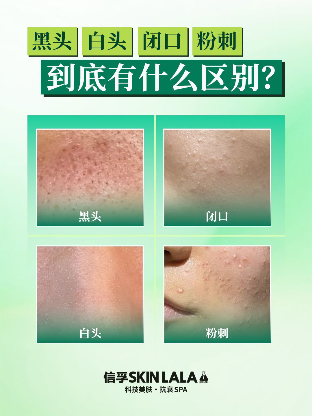 白头粉刺可以自动消失吗