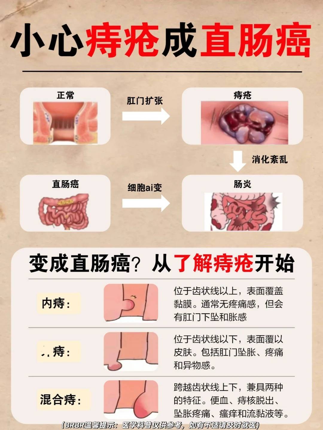 痔疮有什么症状