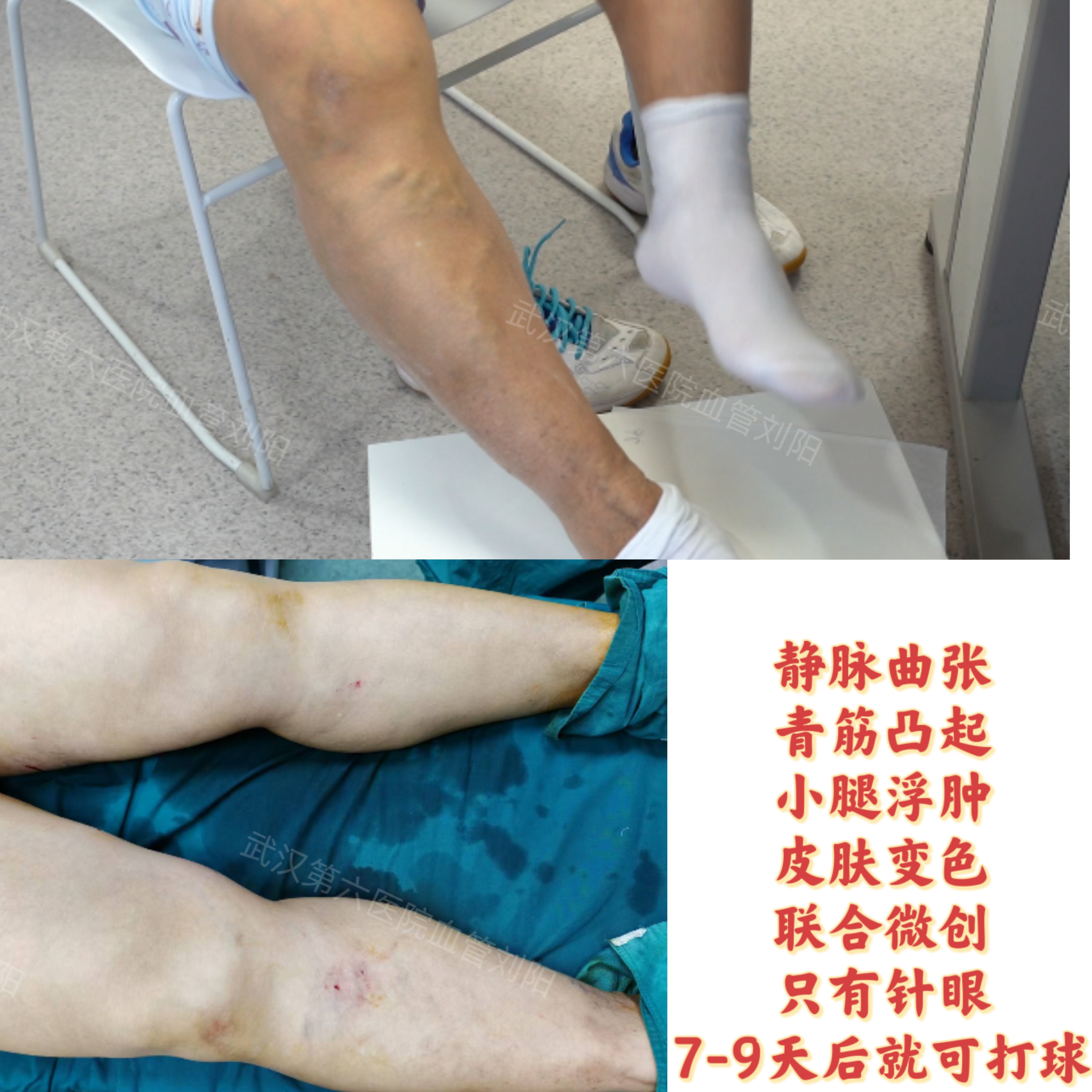 膝盖上的微创手术多久能好