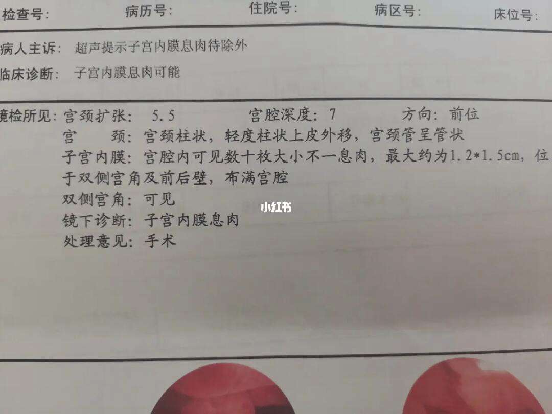 子宫颈息肉是什么?