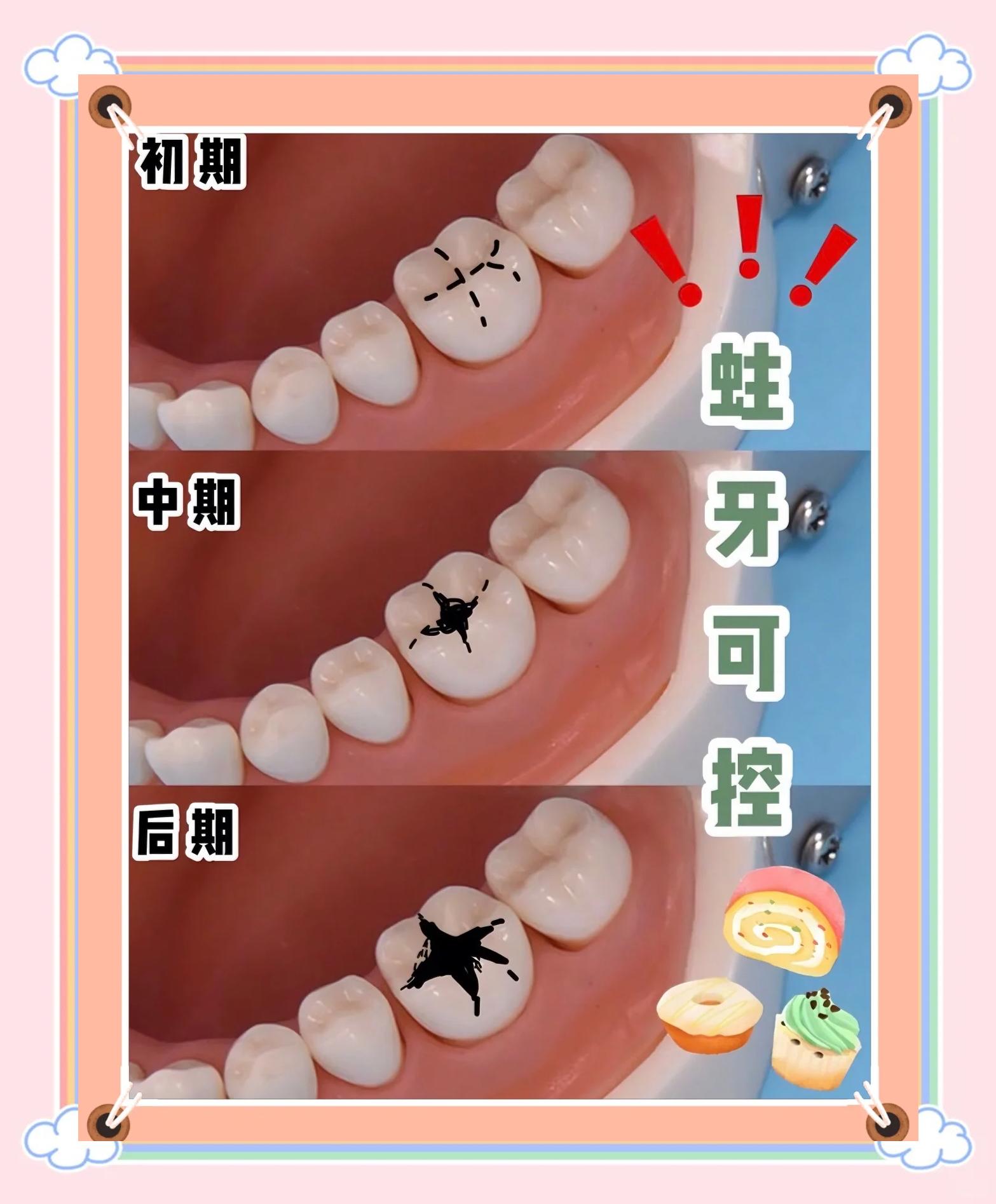 牙齿内侧发黑怎么清除