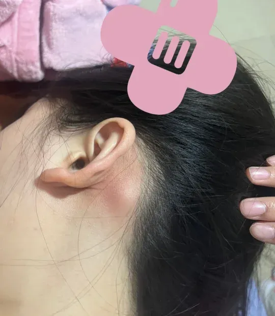 耳朵后面长包是怎么回事