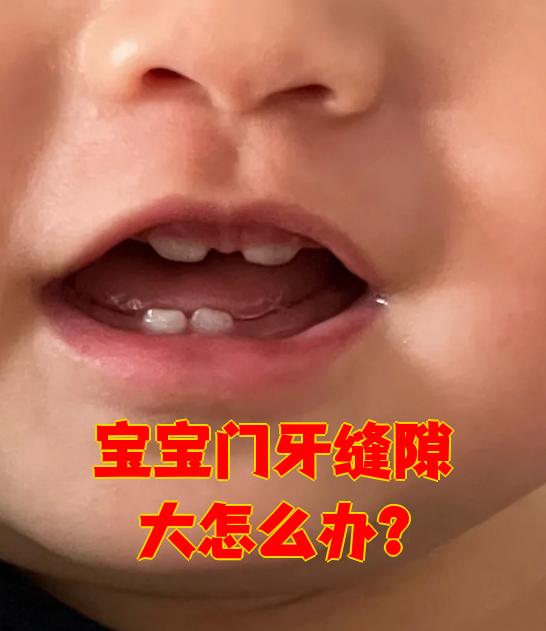门牙有缝怎么办
