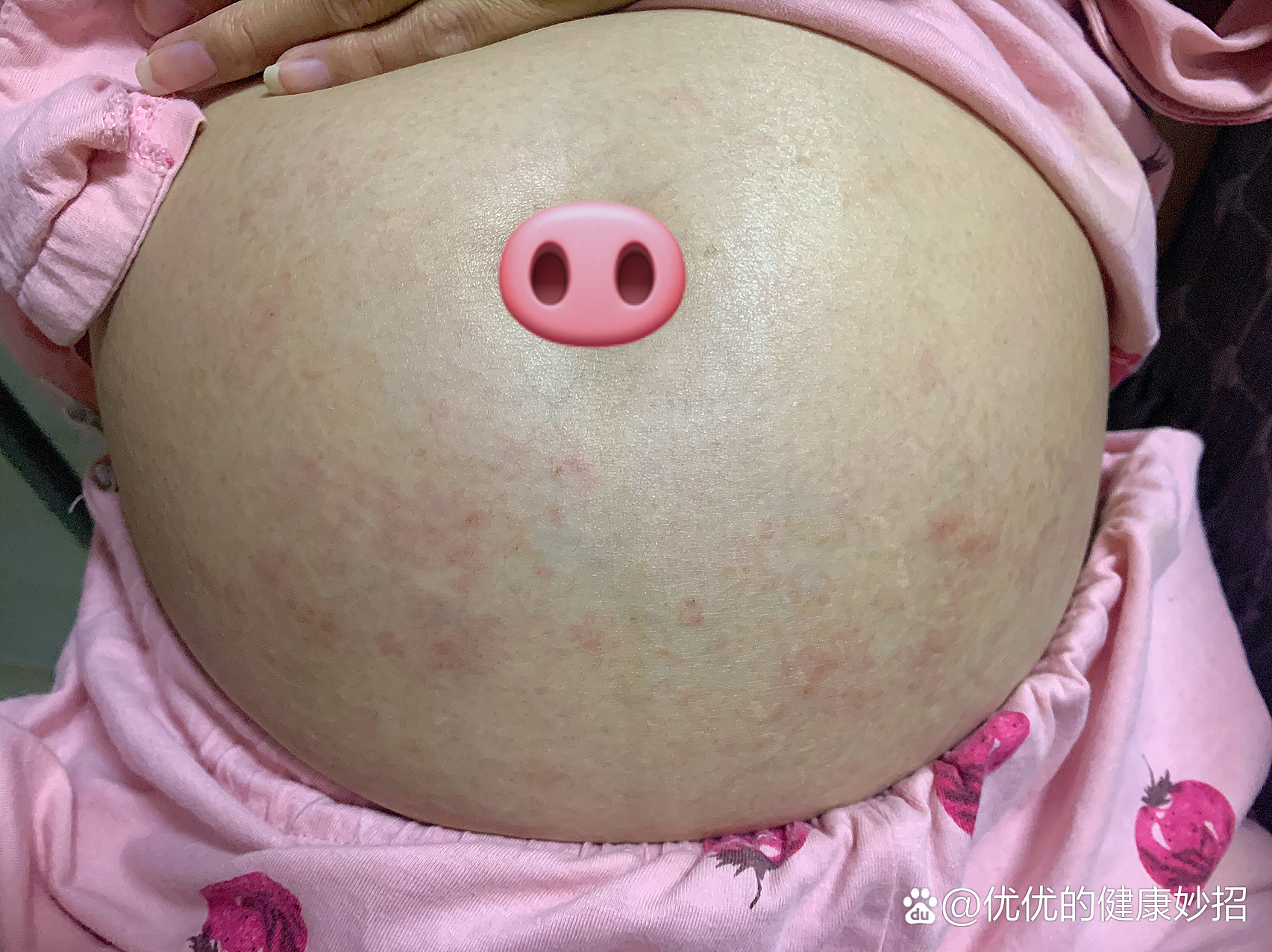 肚子上长红点点怎么回事?