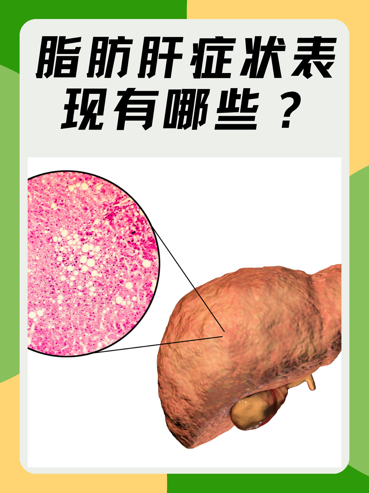 脂肪肝有哪些主要症状