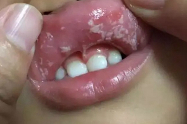 婴儿鹅口疮疼吗