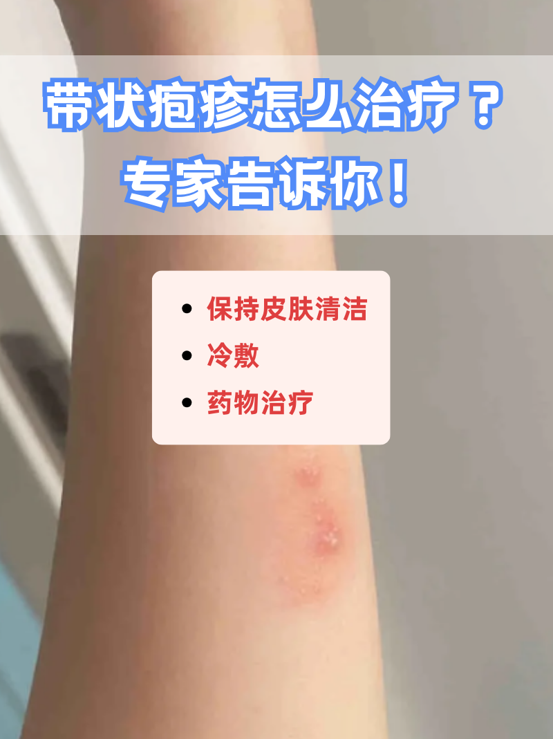 带状疱疹怎么治疗?