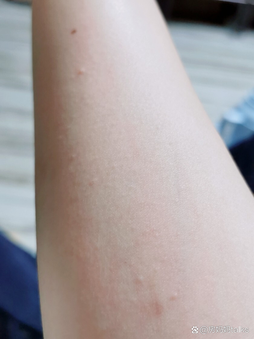 晚上身体痒,越抓越痒