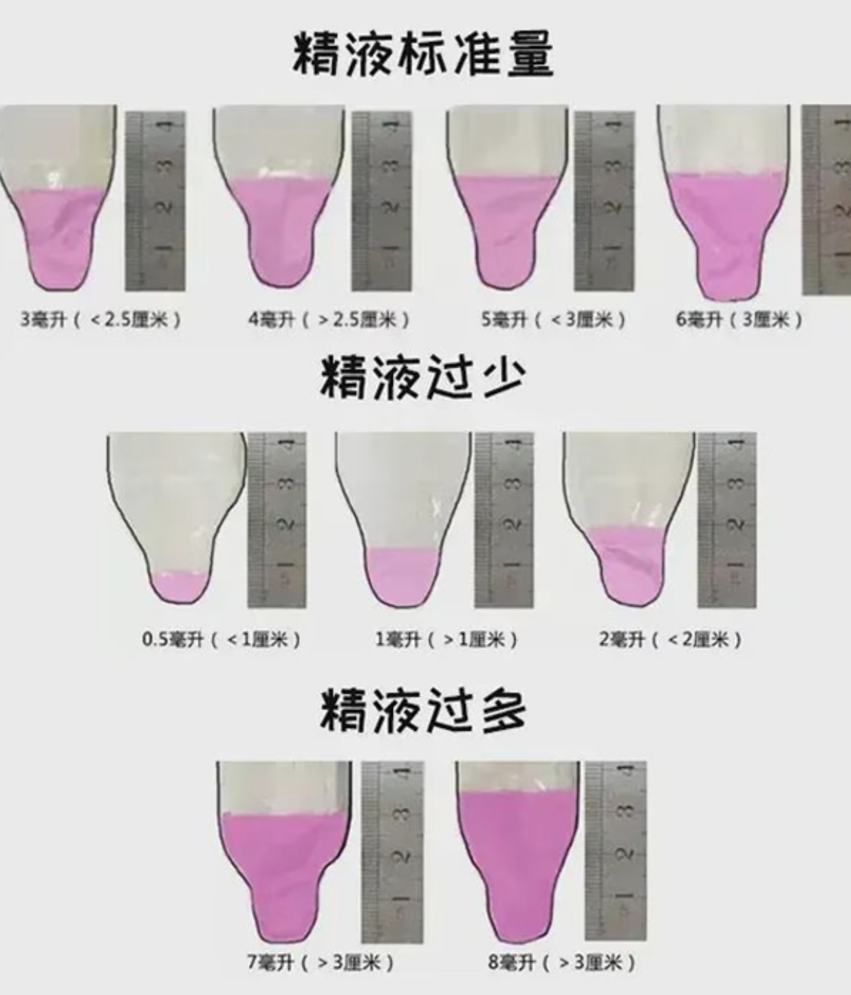 前列腺液里面含有精子吗?