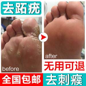 治疗跖疣的药膏有哪些?