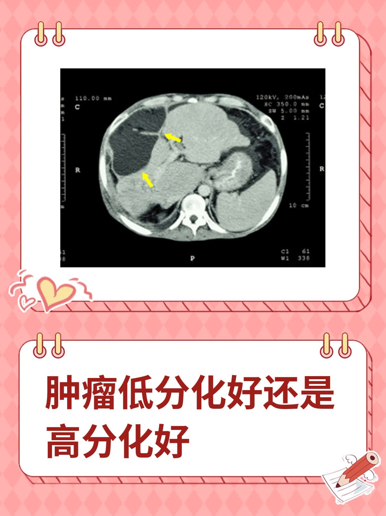 什么是低分化腺癌