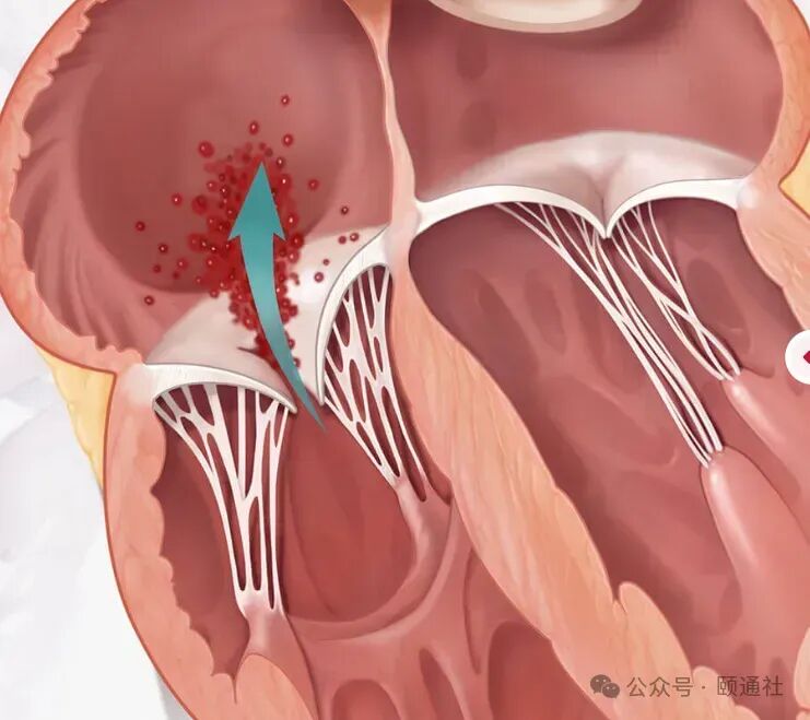三尖瓣轻度返流是什么意思啊