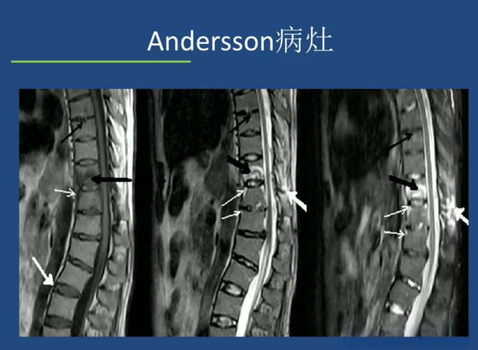 强直性脊柱炎会瘫痪吗