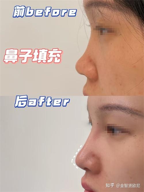什么是玻尿酸隆鼻?