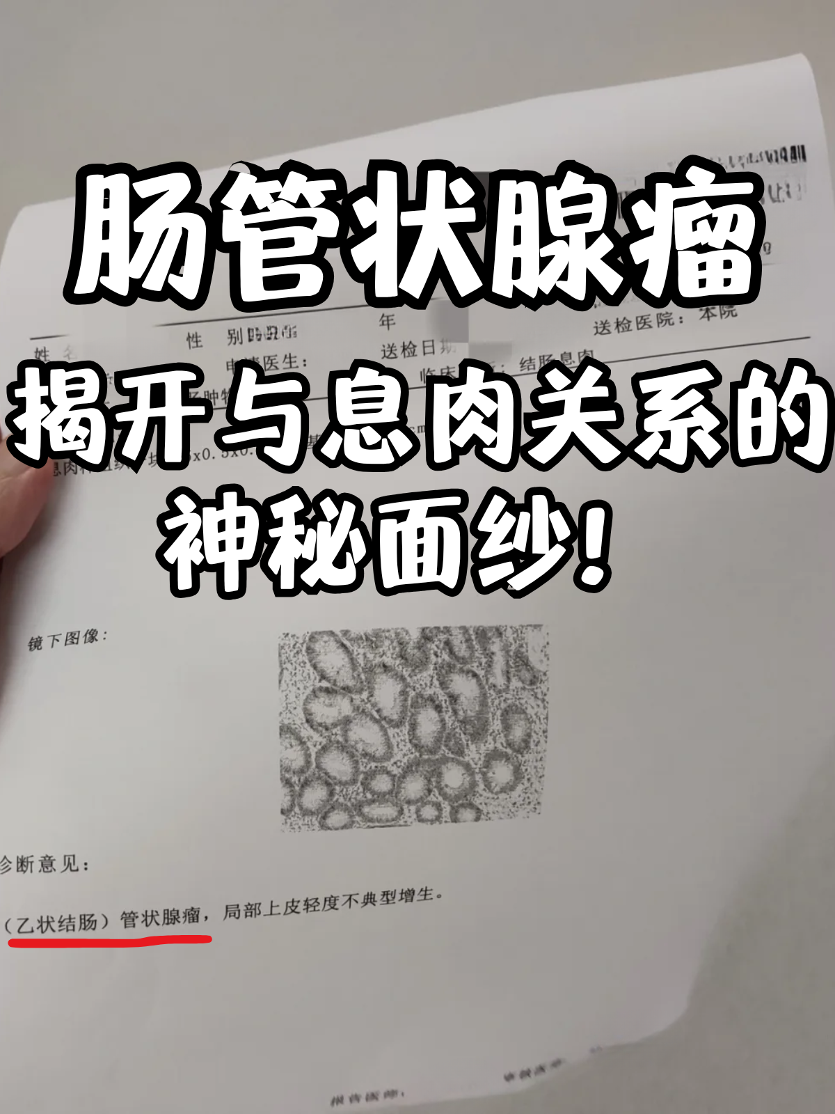 直肠息肉严重吗?