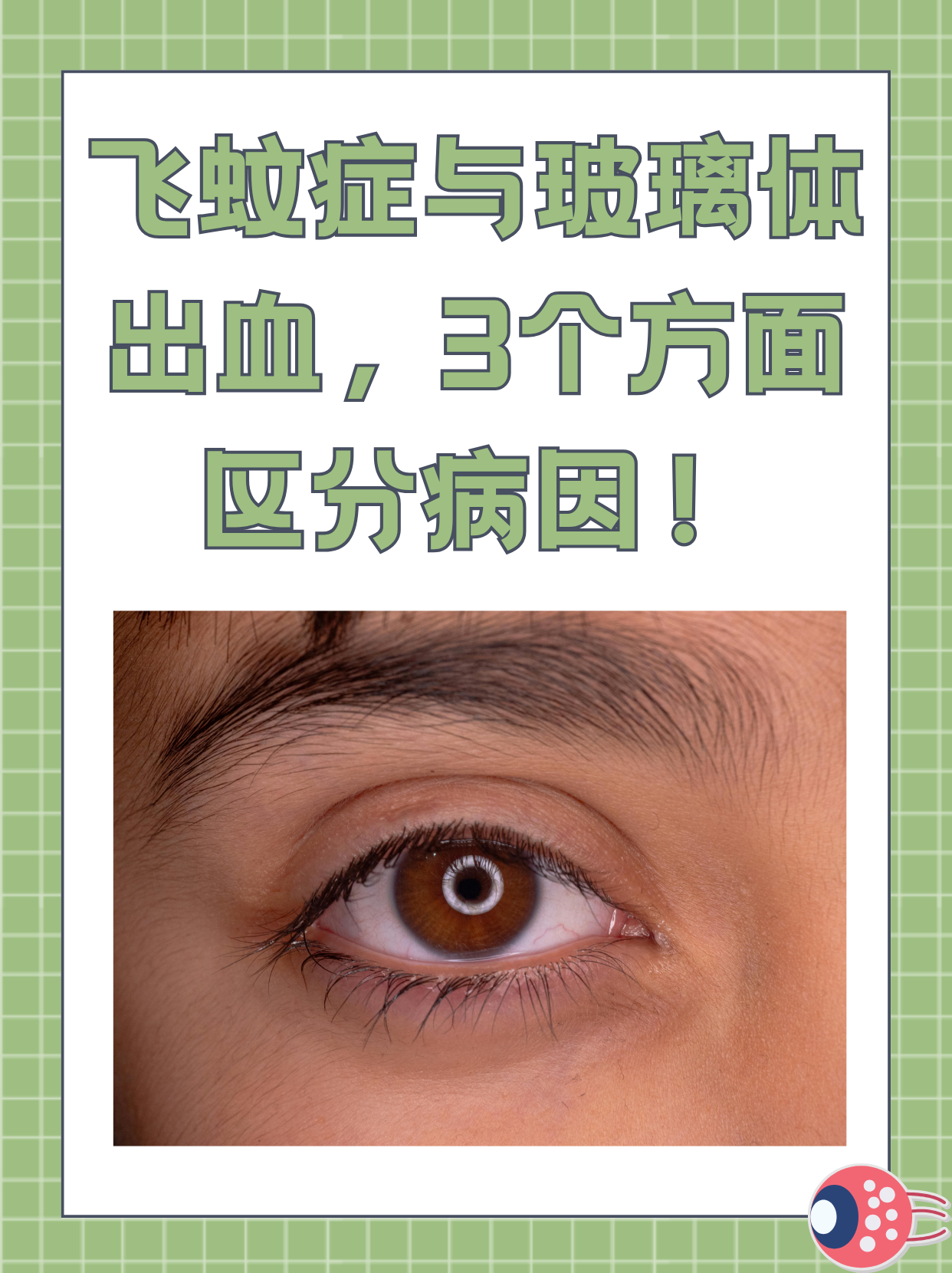 眼睛飞蚊症是什么原因