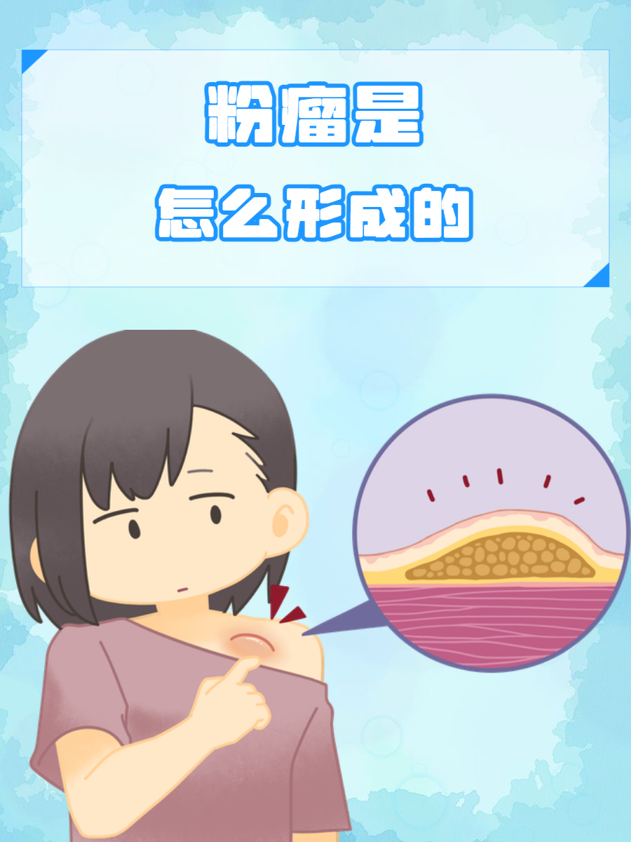 脂肪瘤怎么形成的????
