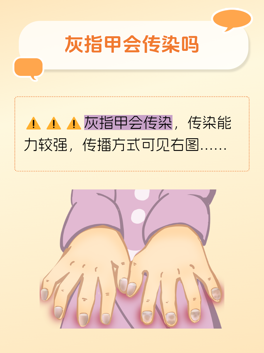 灰指甲会传染吗?