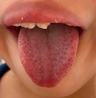 帮忙看看舌头的照片??