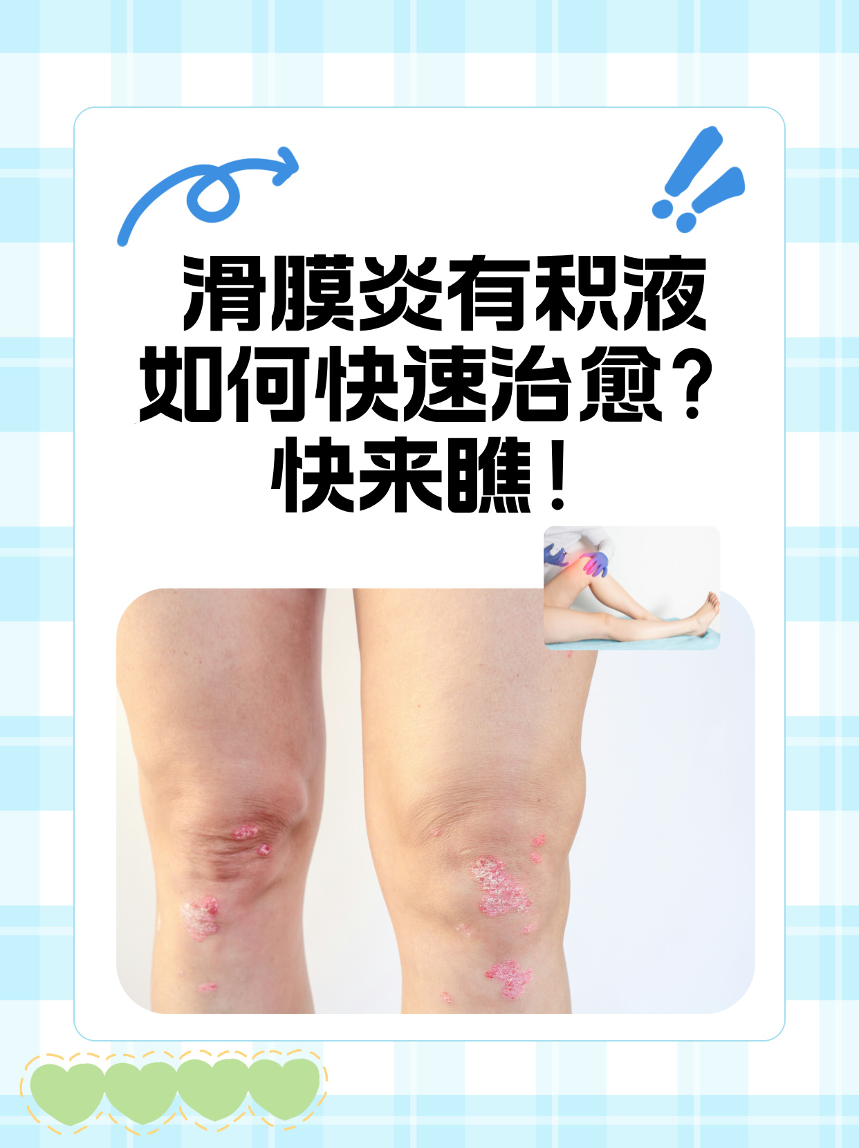 髋关节滑膜炎的症状有哪些?